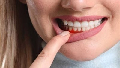 خلي بالك.. ما هي علامات التهاب اللثة؟
