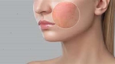 منها الأكلات المالحة.. أطعمة ومشروبات تضر حاجز البشرة وتساعد في ظهور التجاعيد