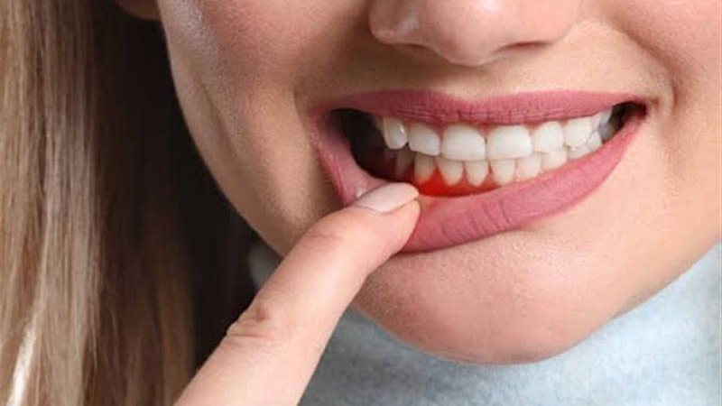 علامات التهاب اللثة