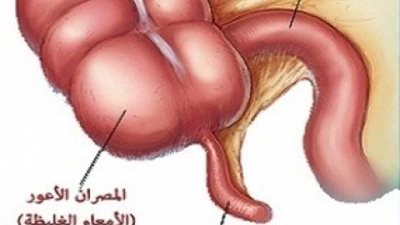 أسباب التهاب الزائدة الدودية لدى الأطفال