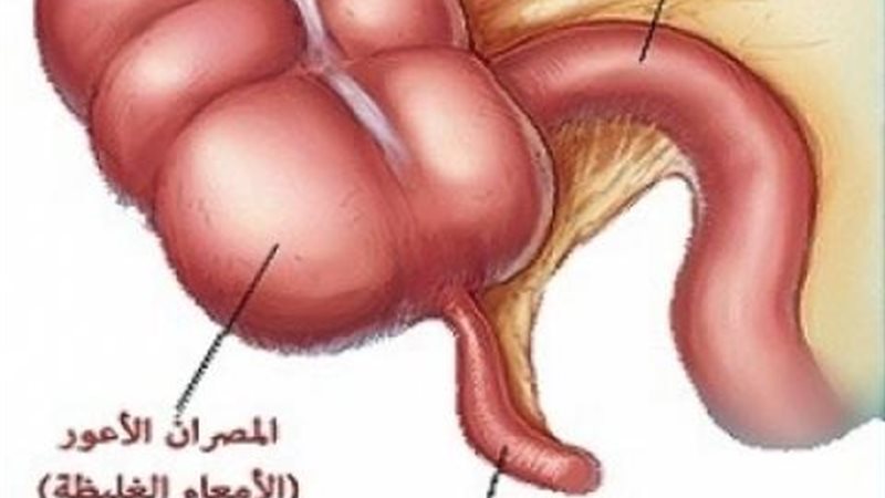 الزائدة الدودية