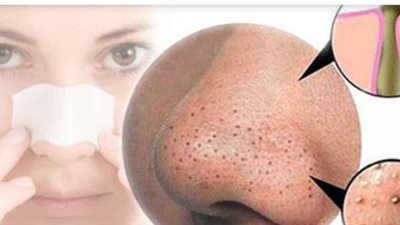 تخلصي من الرؤوس السوداء بهذه الوصفات الطبيعية