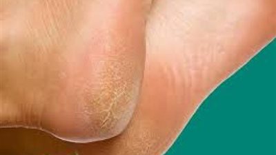8 طرق للتخلص من تشقق القدمين...تعرف عليهم