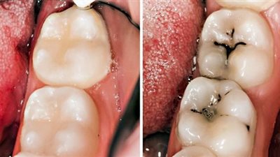 6 مراحل لتسوس الأسنان...يجب زيارة الطبيب قبلها