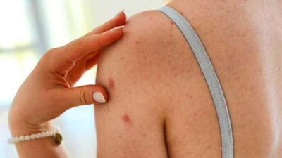 للسيطرة عليه منذ  البداية..6 أعراض للحزام الناري