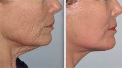 روشتة سحرية لعلاج تصبغات البشرة