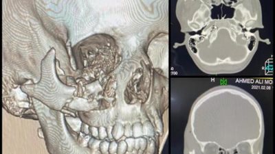 تفاصيل نجاح أول جراحة وجه وفكين بالتأمين الصحي بالأقصر