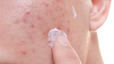 روشتة سحرية لعلاج حب الشباب.. تعرفي عليها