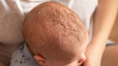 كل ما تريدين معرفته عن أسباب فروة الرأس الجافة عند الأطفال