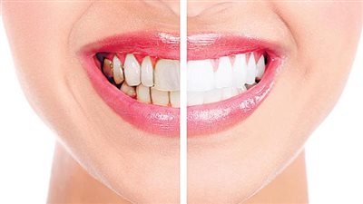 روشتة سحرية لعلاج قرح الفم والتهابات اللثة.. بجنيه واحد