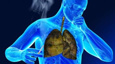 هل انخفضت معدلات الإصابة بمرض الدرن فى مصر بنسبة 20%؟.. وزيرة الصحة تجيب