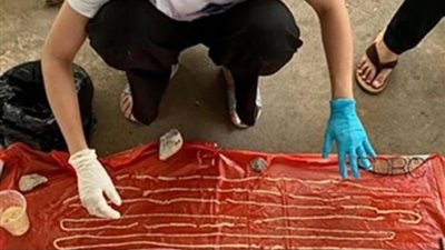 «مش هتصدق».. إخراج دودة عملاقة من معدة مريض طولها 18 متر