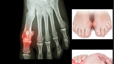 روشتة سحرية لعلاج النقرس في المنزل