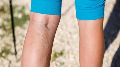 خبيرة تغذية تكتشف طريقة طبيعية لعلاج دوالي القدم دون أدوية