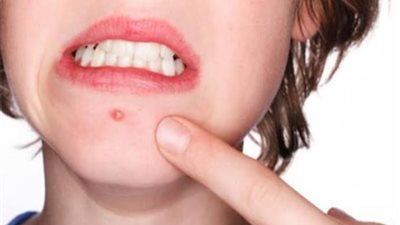 ما هي أسباب لظهور حب الشباب على الذقن؟.. إليك الإجابة