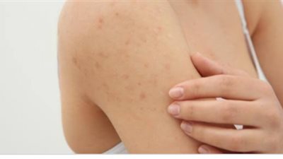 كيف تتخلصين من البثور تحت الجلد؟.. إليك الطريقة