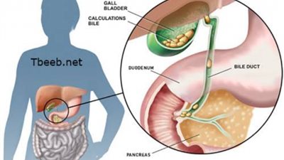 ما هي أعراض الإصابة بالمرارة؟.. تعرفي عليها