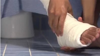 هل يجوز المسح على القدم الموضوعة في الجبس عند الوضوء ؟.. الإفتاء تجيب