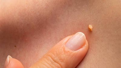 روح الخل.. روشتة سحرية لعلاج الزوائد الجلدية