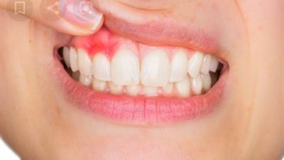 «خلي بالك».. إهمال أمراض اللثة تهدد بالإصابة بمرض خطير جدًا