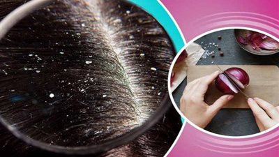 حيل سحرية للتخلص من قشرة الرأس في لحظات