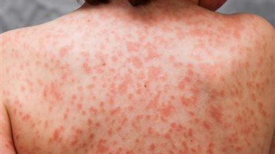 تعرف على طريقة علاج مرض”كاواساكى” الذى يصيب الأطفال