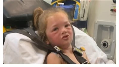 بسبب لدغة حشرة «البق».. تفاصيل مأساة طفلة بعد تشوه وجهها