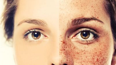 الليمون.. الحل السحري للتخلص من النمش