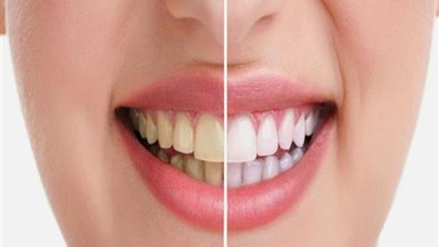 تخلصي من إصفرار الأسنان.. بهذه الطريقة السحرية