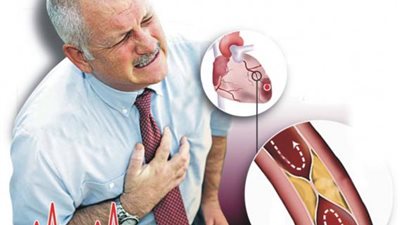 ماذا تعرفين عن أعراض تصلب الشرايين والعلامات الشائعة؟