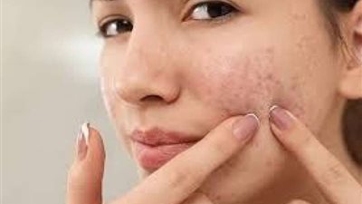 إليك.. منتجات طبيعية للتخلص من حب الشباب خلال الصيف