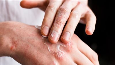 كيف تتخلص من مشكلة حساسية الجلد في الصيف؟.. بهذه الطرق