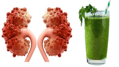 4 مشروبات طبيعية لا تتخلى عنها لتنظيف الكلى.. تعرف عليها