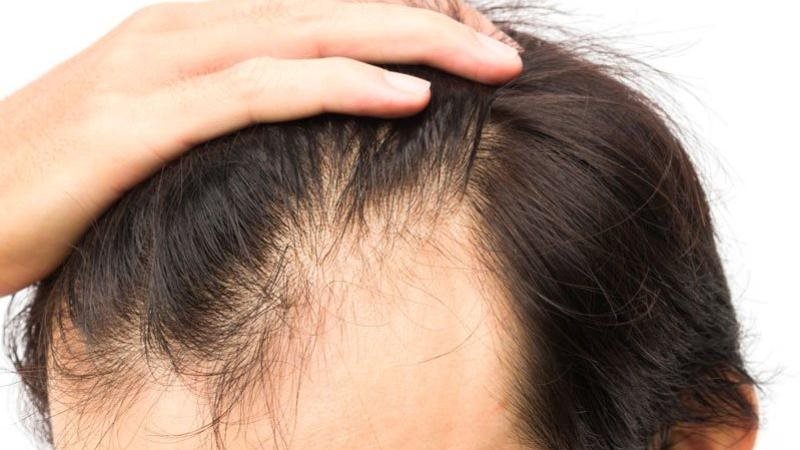 زراعة الشعر للرجال