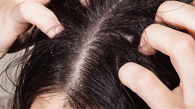 لشعر صحي.. مكونات طبيعية لتنظيف فروة الرأس بفاعلية