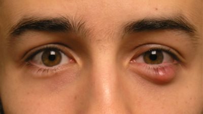 احذر.. أسباب تكون الكيس الدهني.. وهذه طرق التعامل الصحيحة