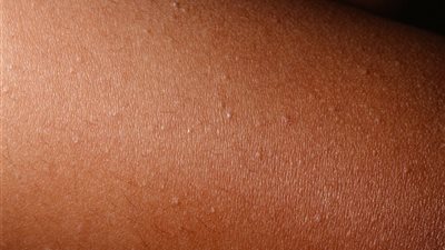 جلد الوزة .. مكونات طبيعية للقضاء عليه