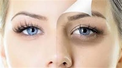 وصفات طبيعية لعلاج الهالات السوداء باستخدام مكونات من البيت