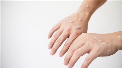 الفرق بين جدري المائي وجدري القرود وكيفية الوقاية