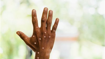 بعد انتشار جدري القرود .. نصائح للوقاية منه