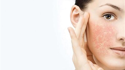 في الحر.. مكونات طبيعية لتخفيف حروق الشمس