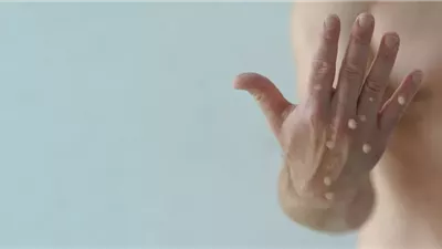 عادات يومية خاطئة تعزز فرص الإصابة بمرض جدري القرود