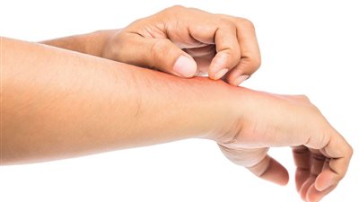 ما هو الطفح الحراري وما هي أسبابه؟