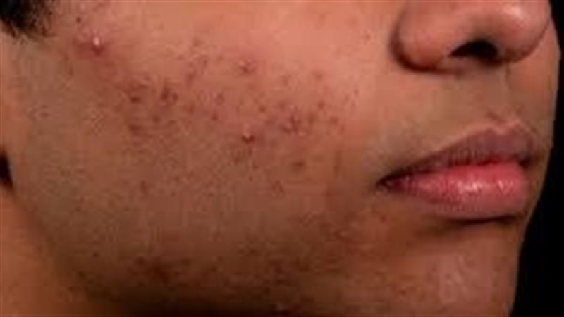 طرق الوقاية من حب