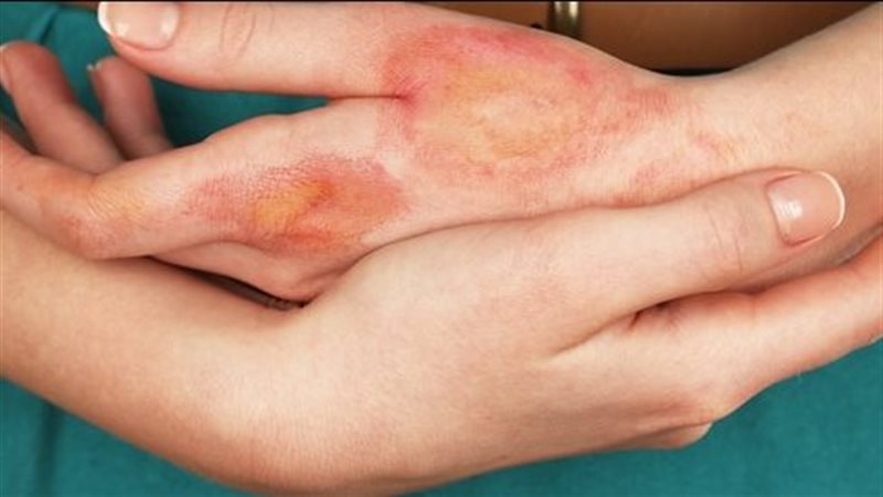 كريمات علاج الحروق