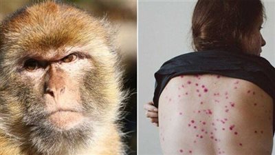  أخبار جدري القرود في مصر.. تعرف على كيفية انتشار المرض 