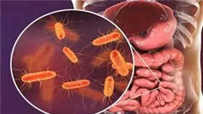 بعد انتشارها في أسوان.. أعراض بكتيريا الإيكولاي وطرق الوقاية