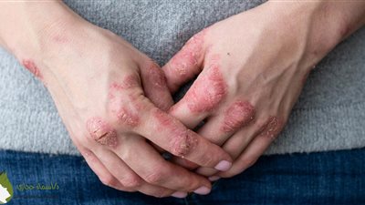 ما هي أسباب الصدفية؟ ومتى تستمر مدى الحياة 