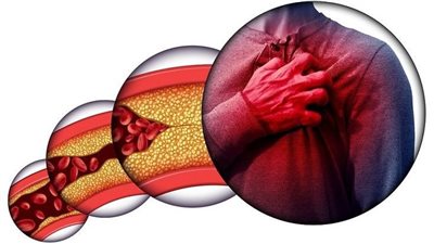 السكتة الدماغية والذبحة الصدرية..إحذر من إرتفاع الكوليسترول في الدم