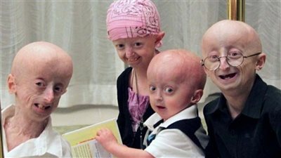 بعد رحيل سامي باسو.. أسباب الشيخوخة المبكرة والفوارق مع التغيرات الطبيعية